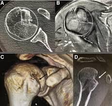 ct scan right shoulder price