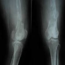 X-ray Left Femur AP & LATERAL View | Medifyhome