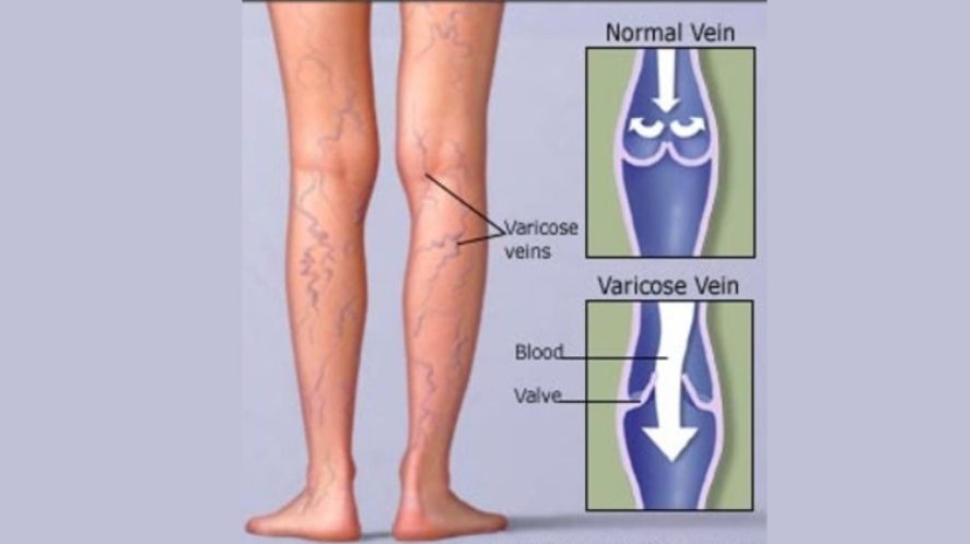 Varicose Veins