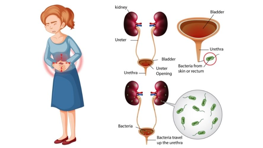 urinary tract infection