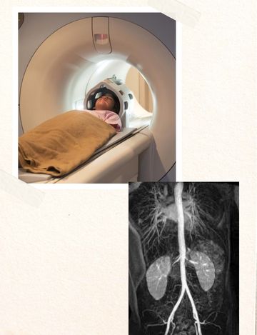 renal angiogram