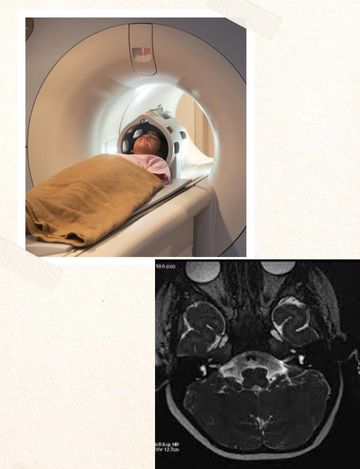 Mri scan for inner ear