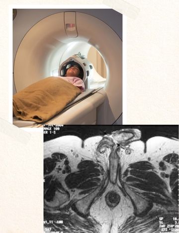 Mri scan for Perineum