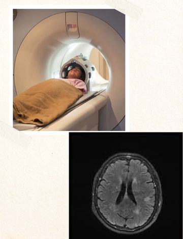 brain stroke protocol