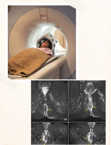 MRI Scan for Fistulogram