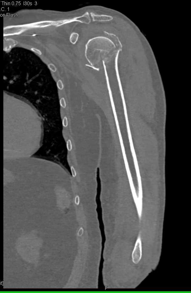 Ct scan Humerus Ct Scan Humerus