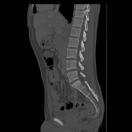 CT Scan of Tailbone