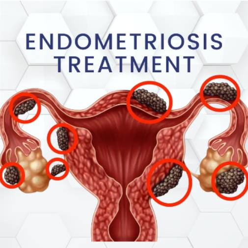 Endometriosis Treatment