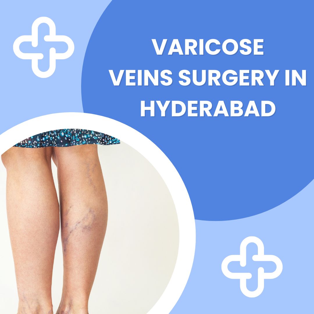 Varicose veins surgery in hyderabad