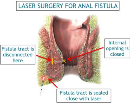 anal fistula surgery in hyderabad