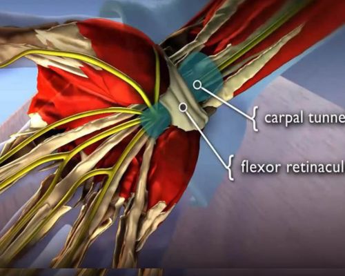 carpal tunnel syndrome