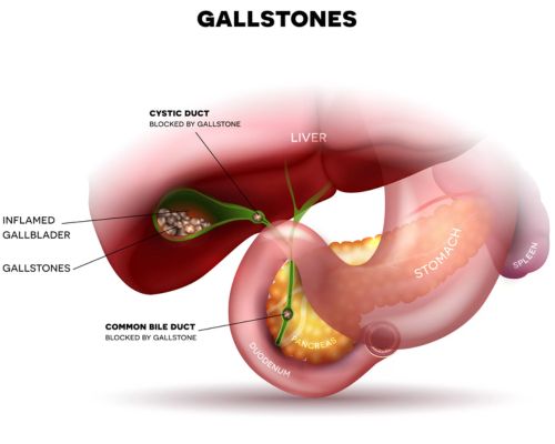gall stones surgery