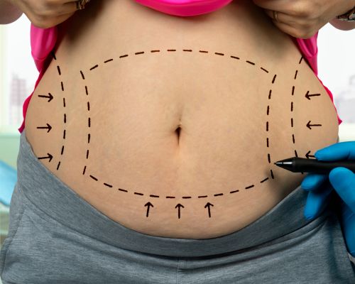 Liposuction