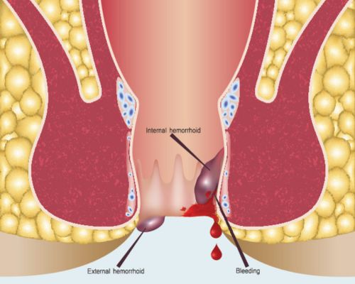 Piles Treatment