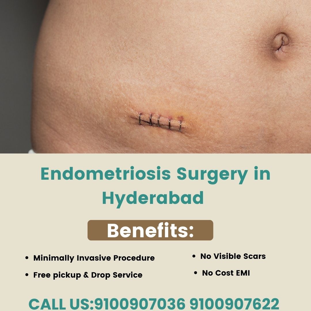 Endometriosis Surgery in Hyderabad
