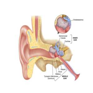 Mastoidectomy Surgery
