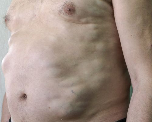 Lipoma Surgery