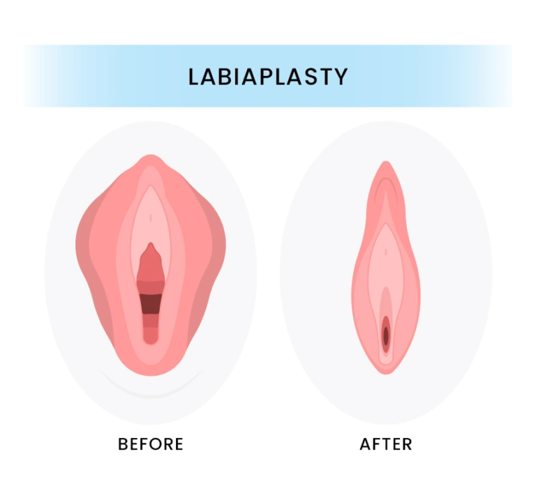 Overview of Labiaplasty
