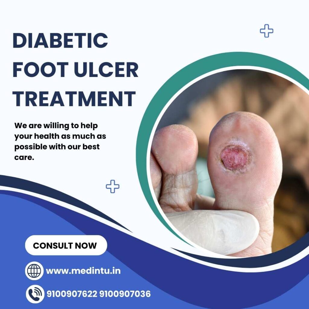 Ddiabetic Foot Ulcer Treatment