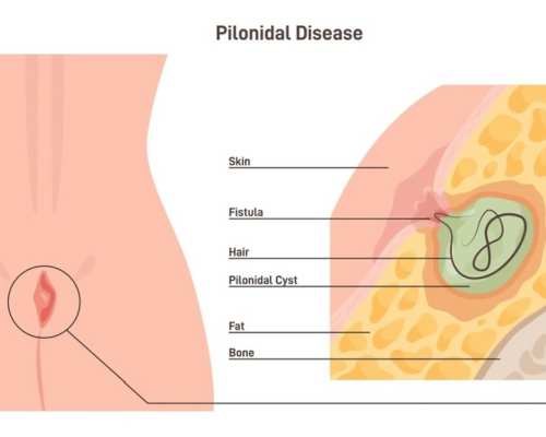 Pilonidal sinus