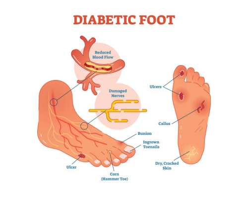 Diabetic Foot Ulcer