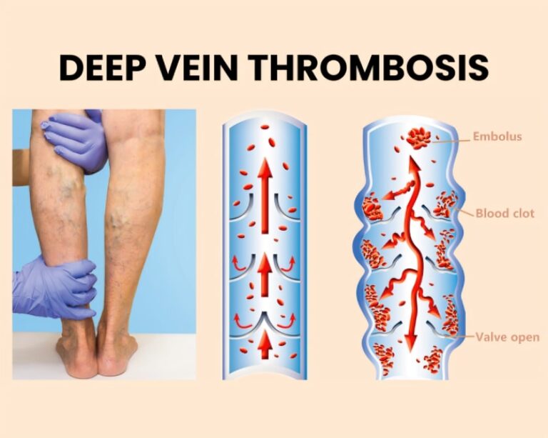 Deep Vein Thrombosis