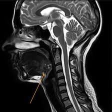 MRI-Neck-Screening