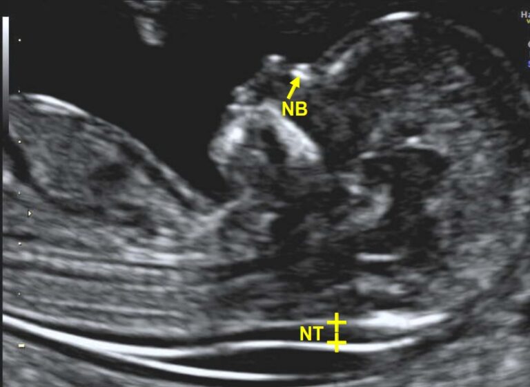 Ultrasound NT & NB Test