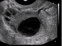 Follicular Study Ultrasound Scan