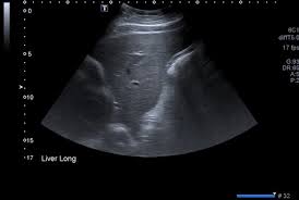 USG Upper Abdomen