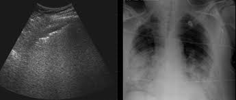 Ultrasound Chest