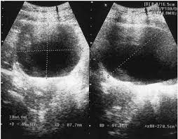 Ultrasound Post Void Residual