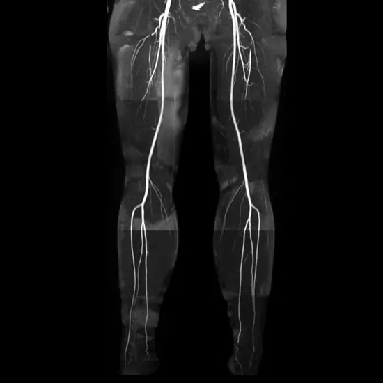 mr-angiography-both-lower-limb