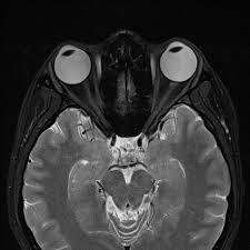 mri-orbits