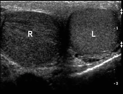 Ultrasound for Testis