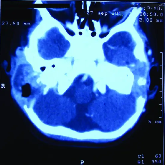 CECT Temporal Bone Axial View