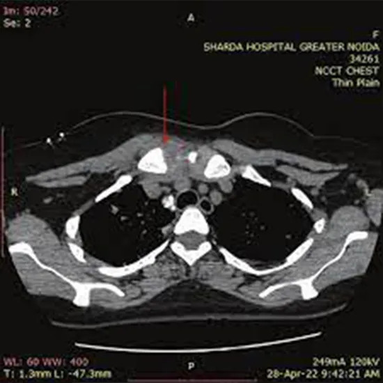 NCCT Sternoclavicular