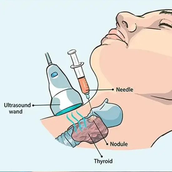 Ultrasound Guided Aspiration