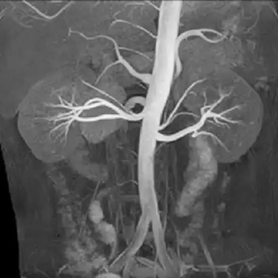MR Renal Venography