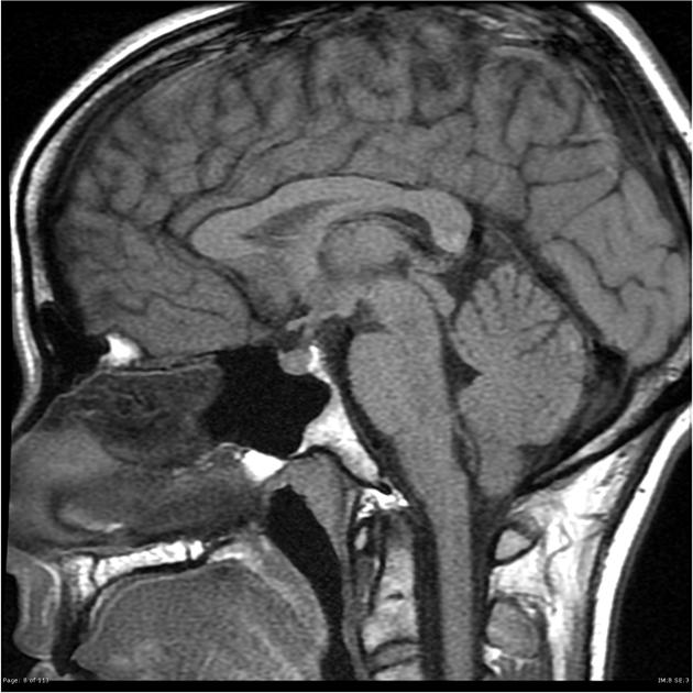 MRI Brain of Pituitary