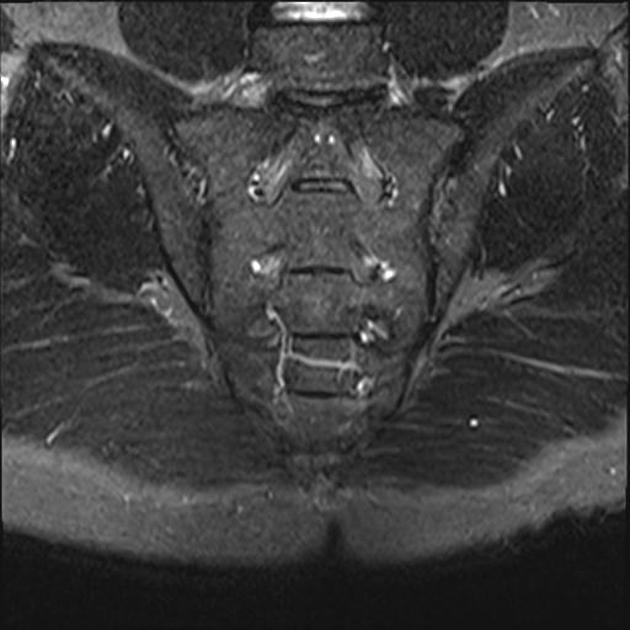 MRI Both SI Joints