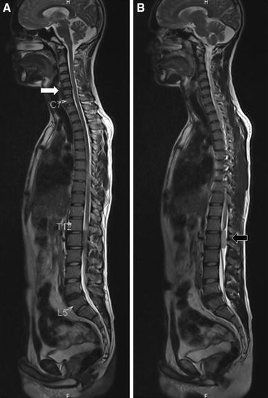 MRI Screening Of Dorsal Lumbar Spine