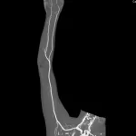 CT Angiography Venous Upper Limb