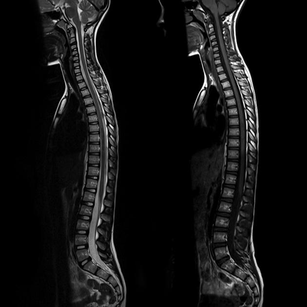 MRI Screening Of the Whole Spine