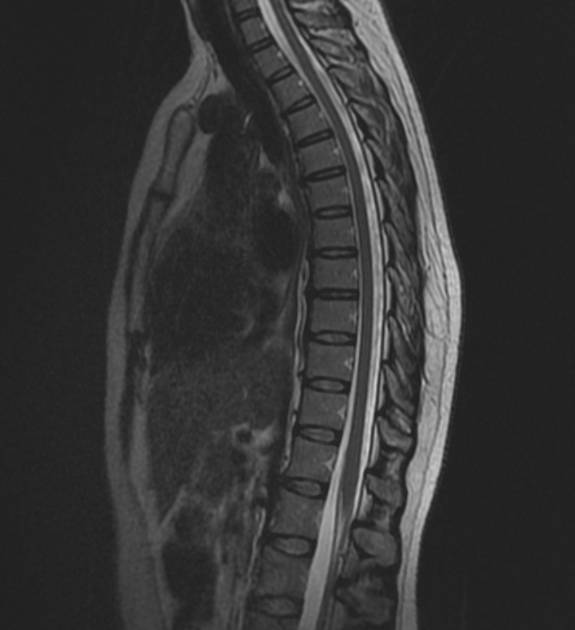 MRI Thoracic Spine