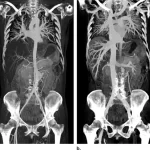 Whole Body CT Angiography