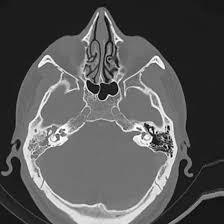 CECT-Both-Mastoid