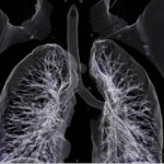 CECT Chest With Virtual Bronchoscopy