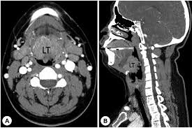 CECT Hard Palate