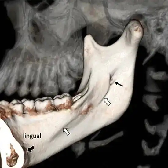 CECT Right Mandible